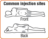 Common injection sites